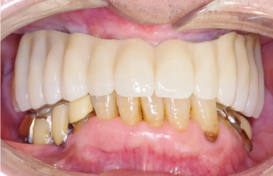 70代男性のインプラント（歯12本分）：治療後